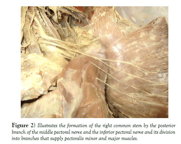 international-journal-anatomical-variations-stem