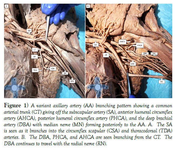 international-journal-anatomical-variations-subscapular