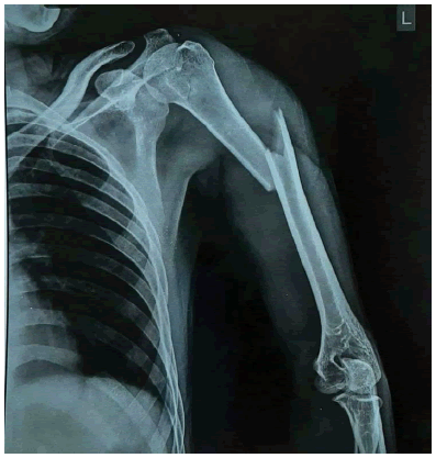 Humeral intramedullary nail bending following trauma: a case report