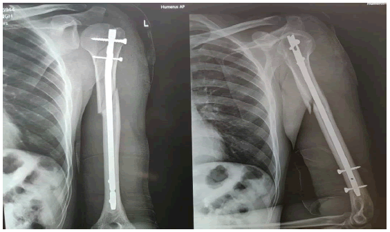 PDF] Comparison of retrograde intramedullary nailing and bridge plating in  the treatment of extra-articular fractures of the distal femur. | Semantic  Scholar