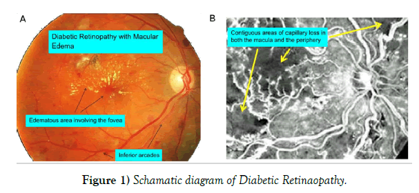 journal-pure-applied-mathematics-Retinaopathy