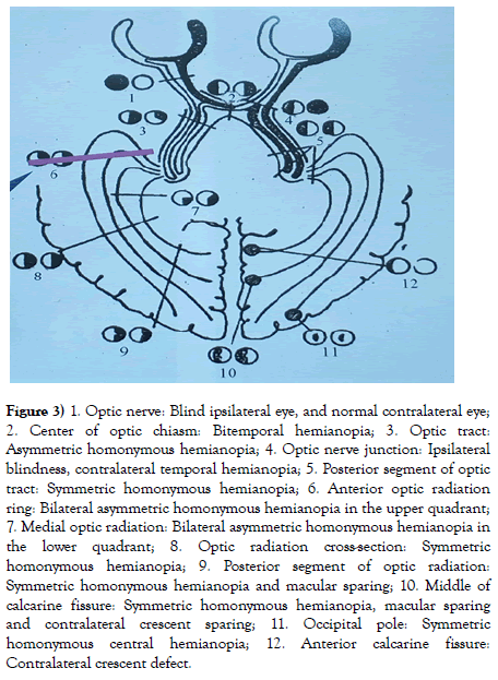 neurology-clinical-neuroscience-optic-chiasm