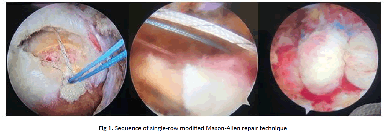 Surgical outcomes of arthroscopic rotator cuff repair with modified  Mason-Allen suture technique combined with microfracture procedure at the  attachment site