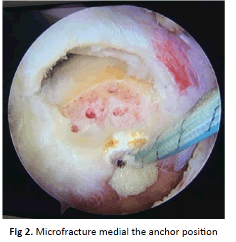 orthopaedics-trauma-anchor-position