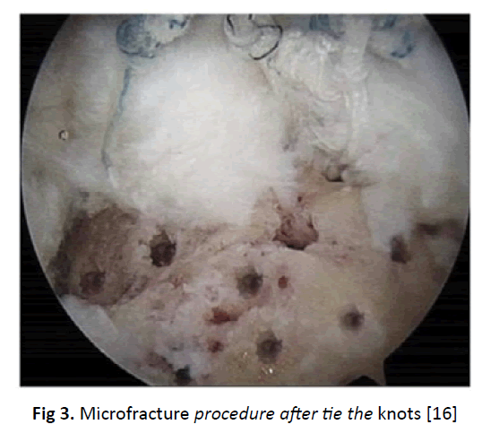 orthopaedics-trauma-anchor-procedure