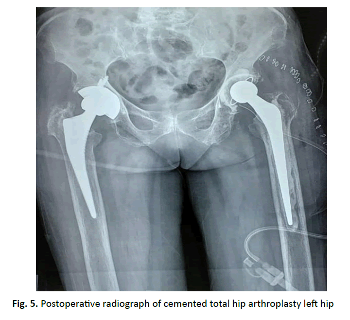 orthopaedics-trauma-arthroplasty-left