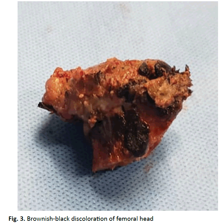 orthopaedics-trauma-femoral-head