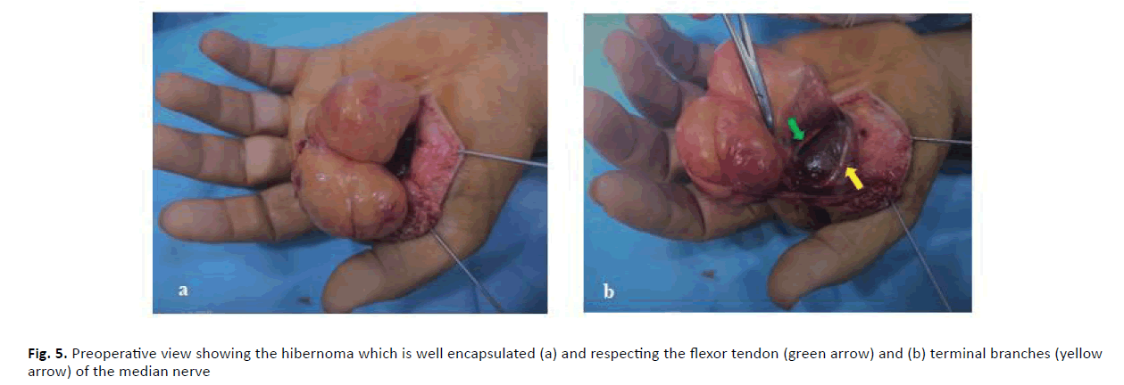 orthopaedics-trauma-flexor-tendon