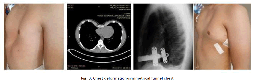 orthopaedics-trauma-funnel-chest