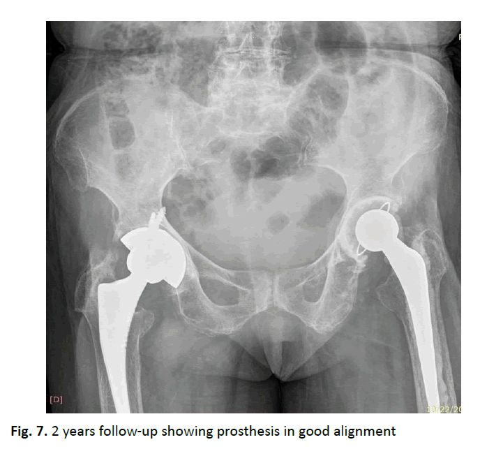 orthopaedics-trauma-good-alignment
