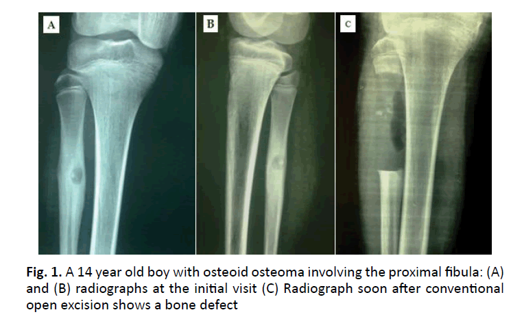 orthopaedics-trauma-osteoma-proximal