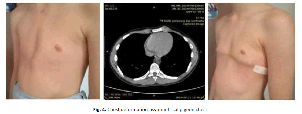 orthopaedics-trauma-pigeon-chest