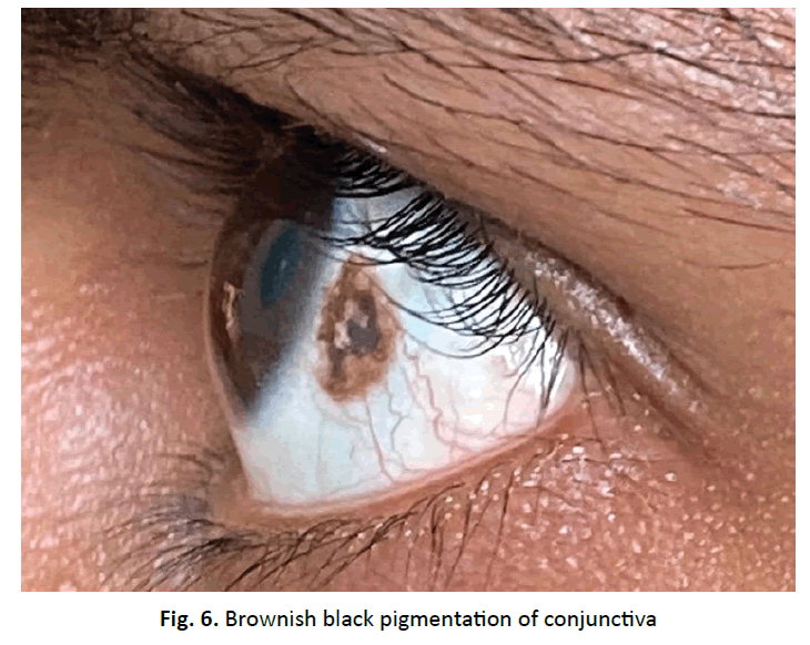 orthopaedics-trauma-pigmentation-conjunctiva