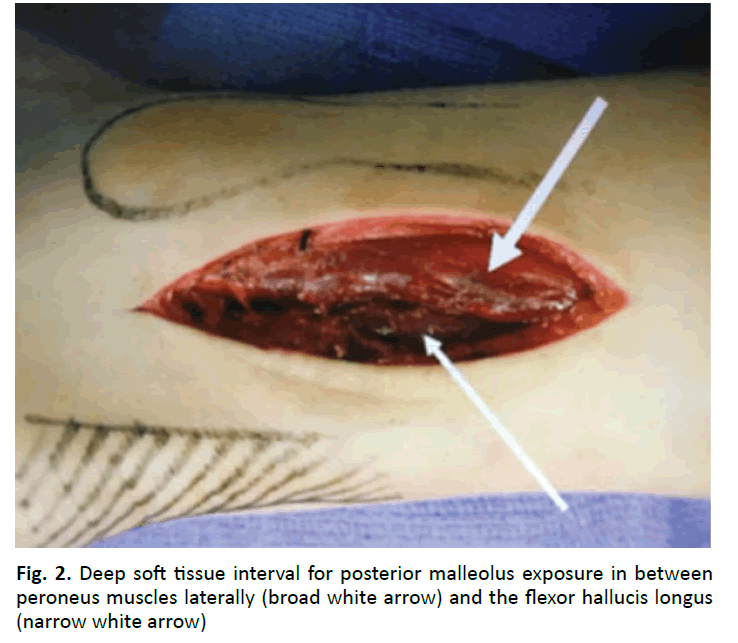 orthopaedics-trauma-posterior-malleolus