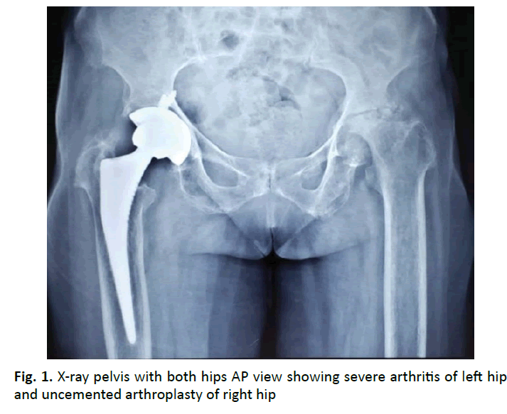 orthopaedics-trauma-severe-arthritis