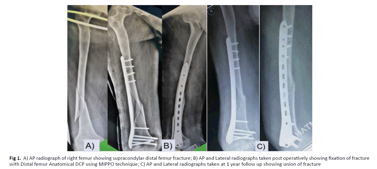 orthopaedics-trauma-surgery-femur-fracture