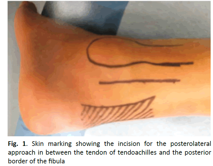 orthopaedics-trauma-tendoachilles-posterior