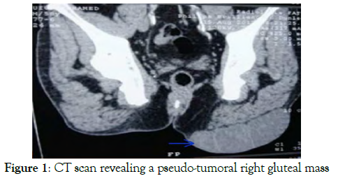 surgery-case-report-gluteal-mass