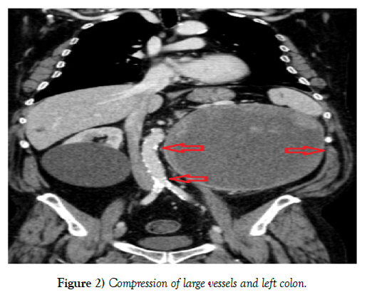 surgery-case-report-renal-tumor