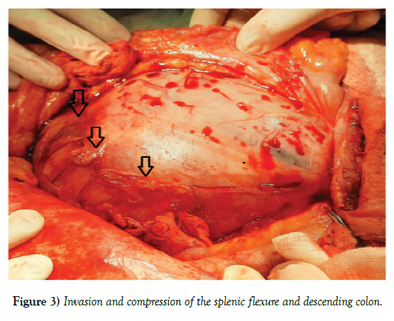 surgery-case-report-renal-tumor