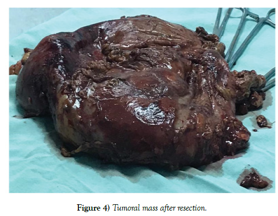 surgery-case-report-renal-tumor