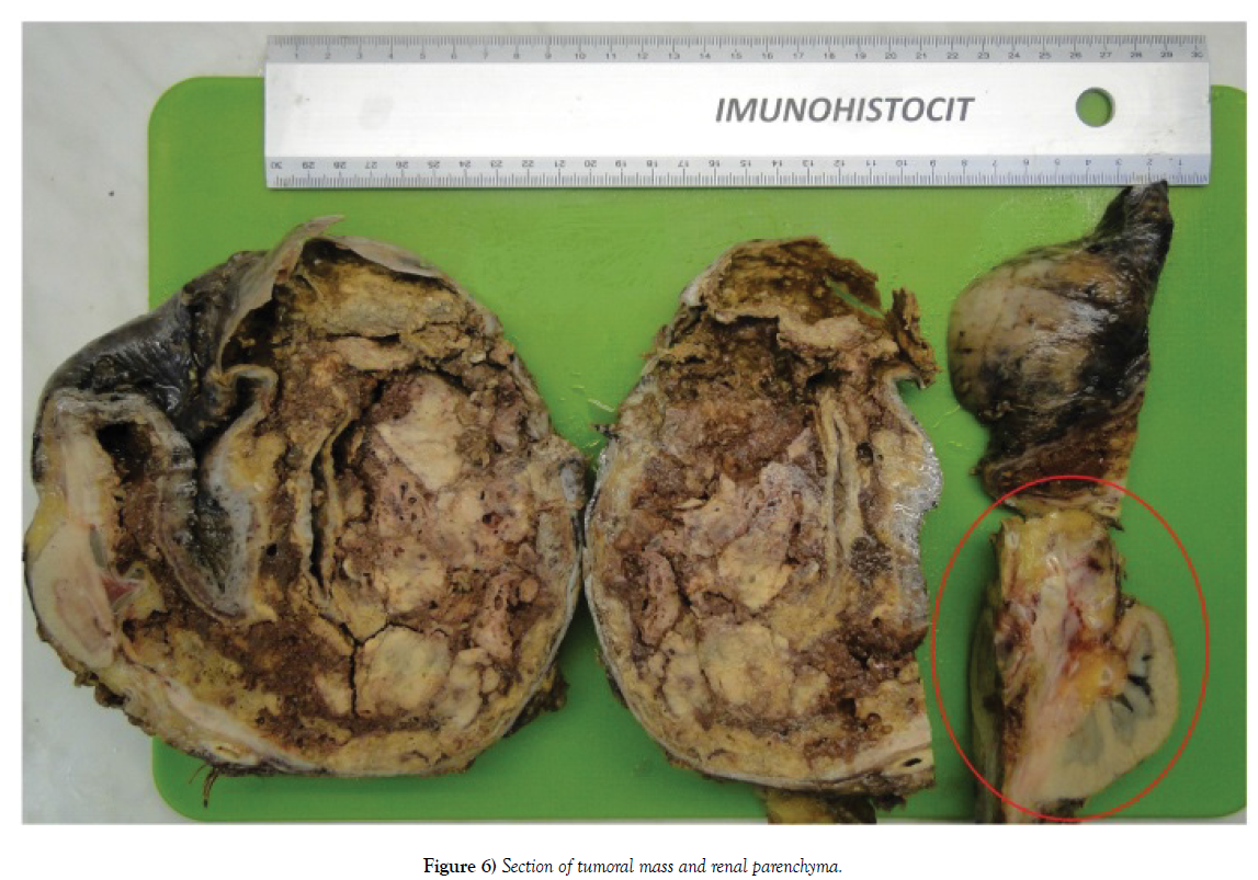 surgery-case-report-renal-tumor