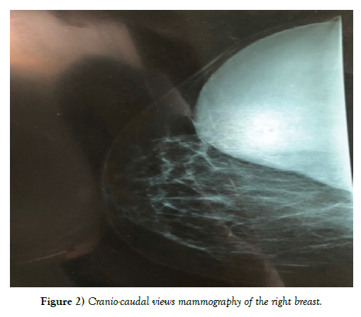 surgery-case-report-right-breast