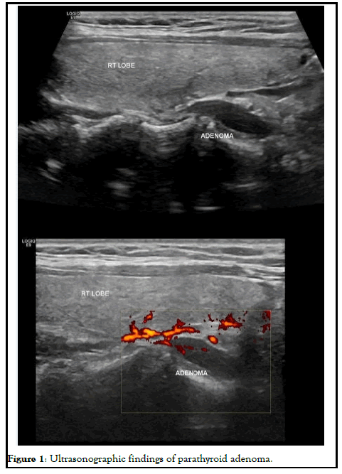 PULJEDS-parathyroid