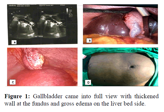 annals-gallbladder