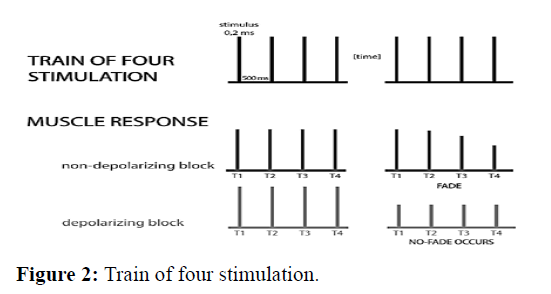 Train of Four - Peripheral Nerve Stimulation 