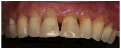 dentistry-case-prosthesis