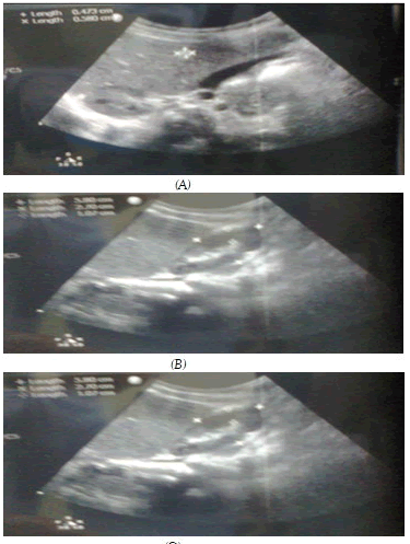 hemangioma-6-2