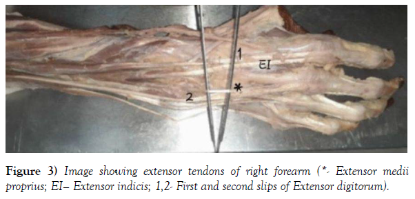 international-journal-anatomical-variations-extensor