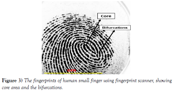 international-journal-anatomical-variations-finger