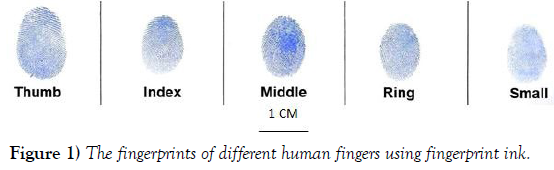 international-journal-anatomical-variations-fingerprints
