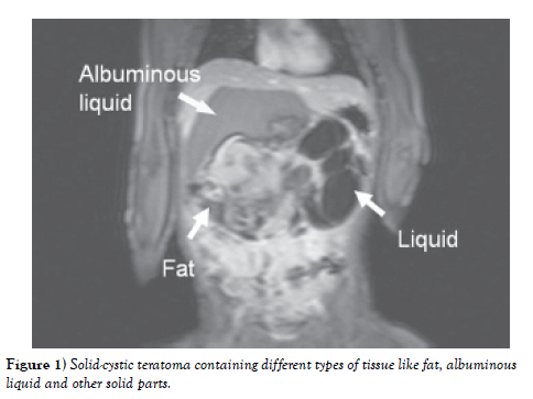 international-journal-teratoma