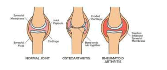 jotsrr-arthritic