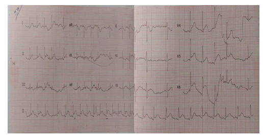 puljhr-5-5-(ECG)-g002