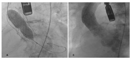 puljhr-5-5-Fluoroscopic