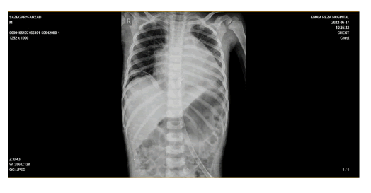 puljhr-5-5-Pericardiocentesis