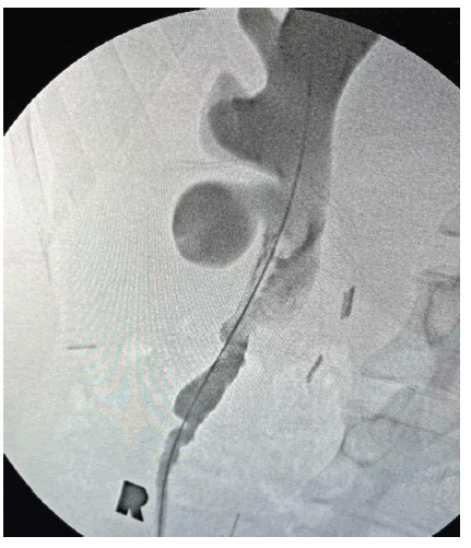 pulscr-angiography