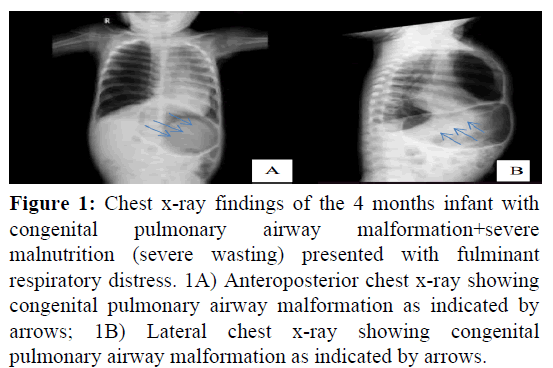 AMHSR-Chest