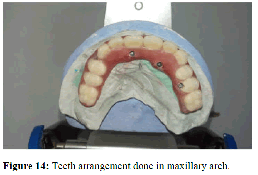 AMHSR-Teeth