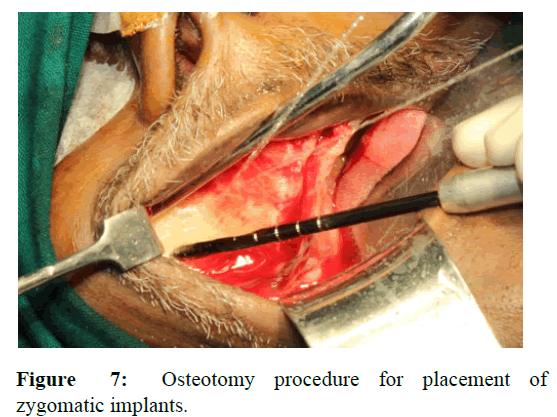 AMHSR-procedure