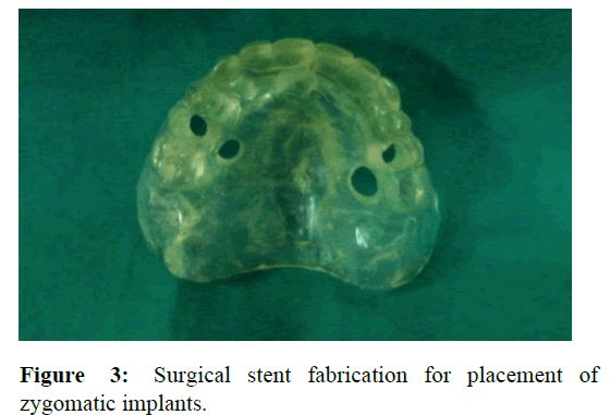 AMHSR-stent