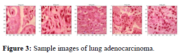 Annals-Research-adenocarcinoma