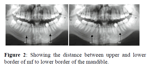 Annals-Research-mandible