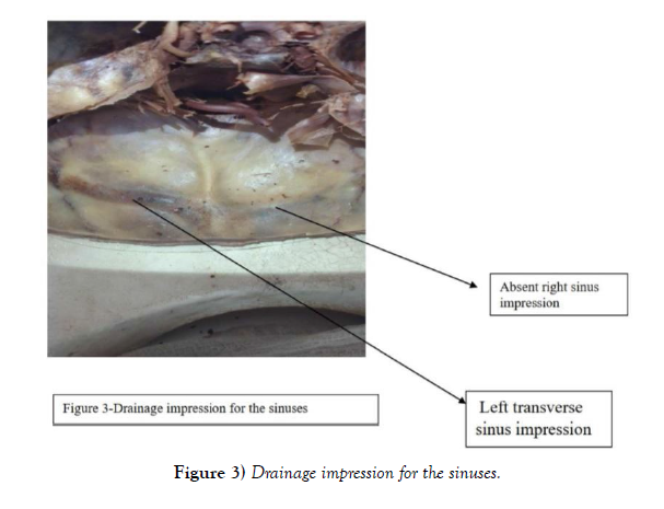 international-journal-anatomical-variations-Drainage