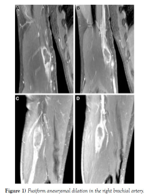 international-journal-anatomical-variations-Fusiform-