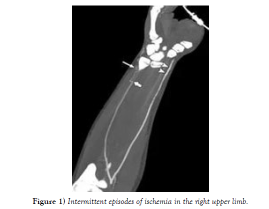 international-journal-anatomical-variations-Intermittent